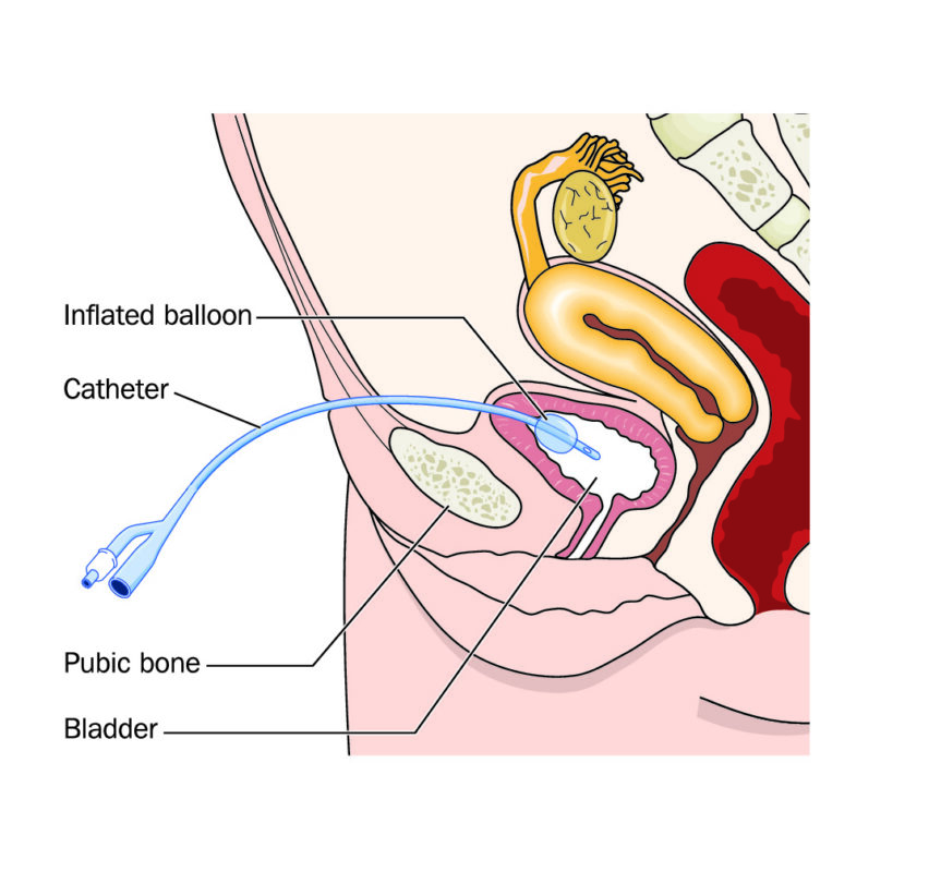 Female Patient Catheter Insertion Techniques